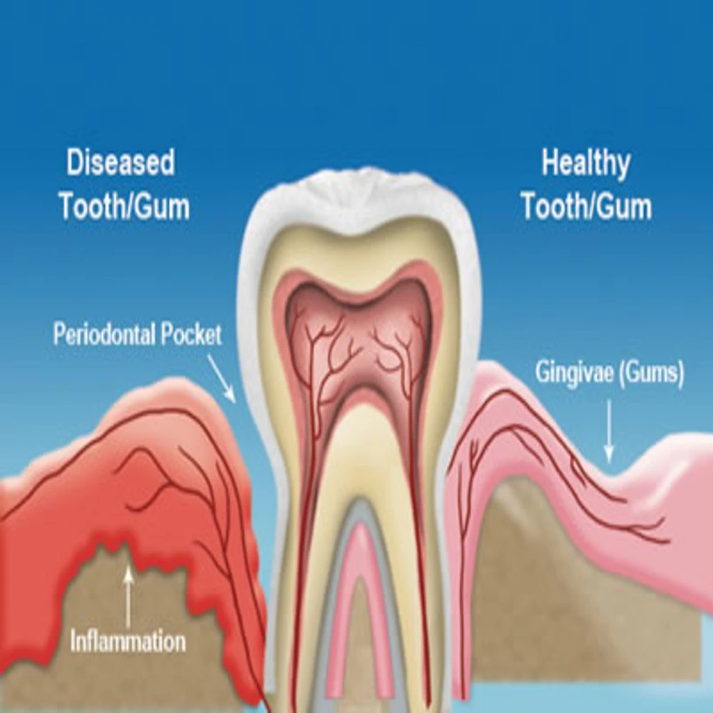 Gum Treatments in Scarborough