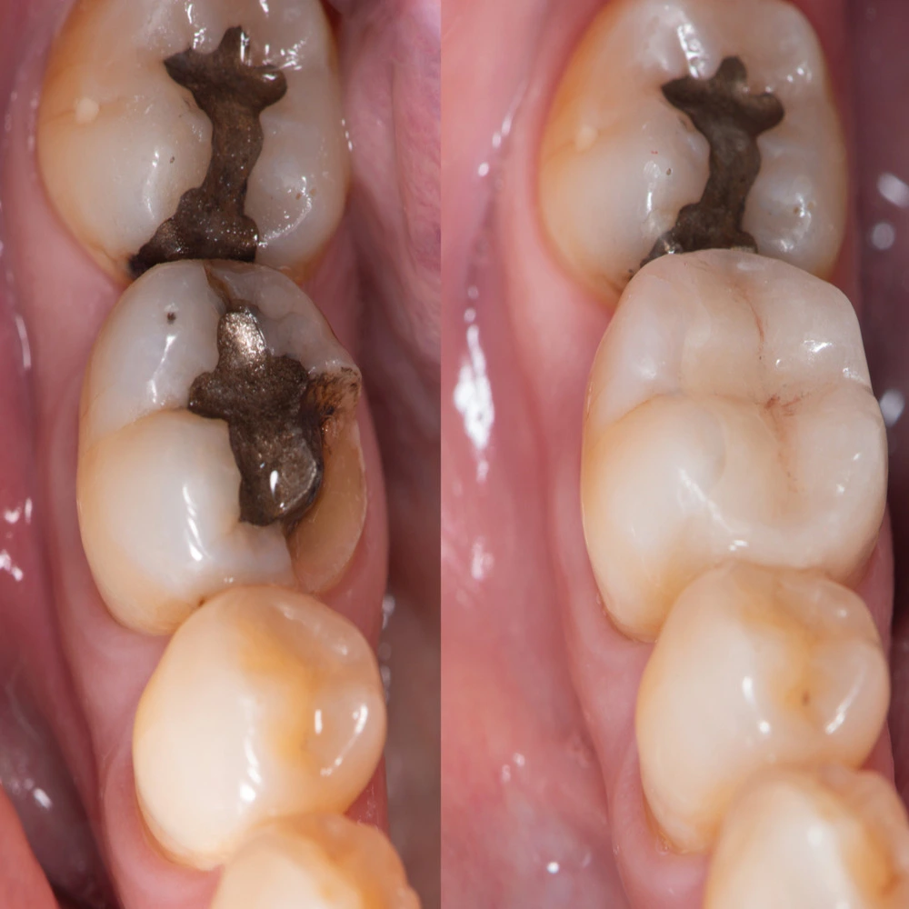 White Fillings in Scarborough