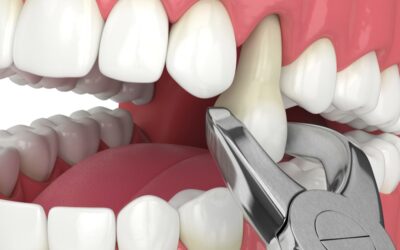 Signs You May Need to Have a Tooth Pulled