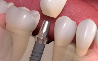 A Comprehensive Guide to the Dental Implant Process