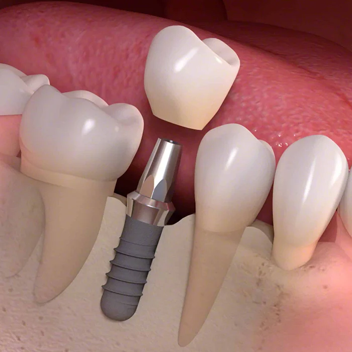dental – implants dental implants