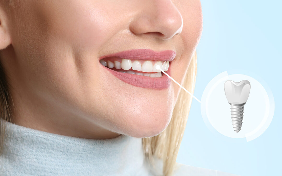 Benefits of Getting Dental Implants