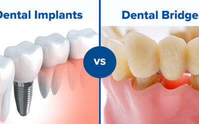 Dental Implants vs. Dental Bridges