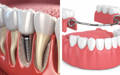 Dental Implants vs. Dentures