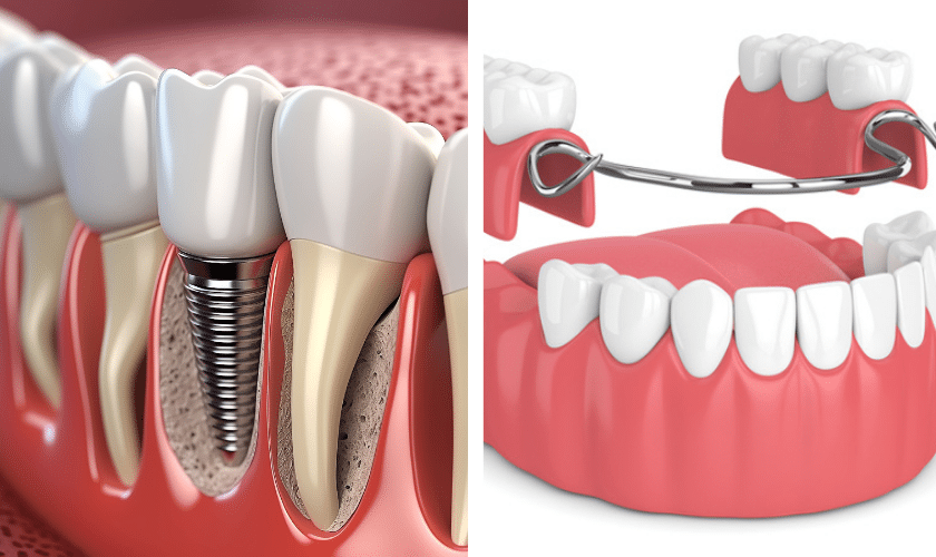Dental Implants vs. Dentures