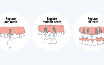 Different Types of Dental Implants