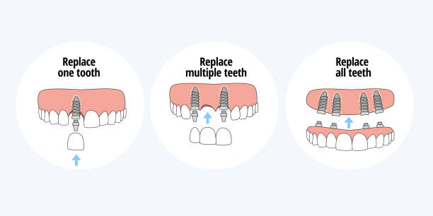 Different Types of Dental Implants