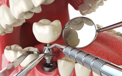How to Prepare For Dental Implant Surgery?