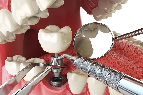 How to Prepare For Dental Implant Surgery?