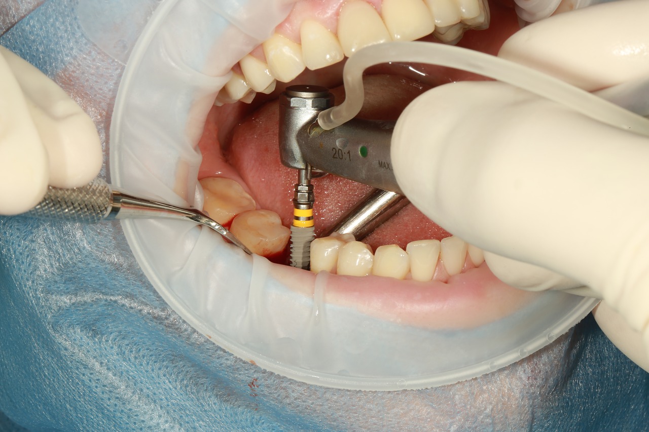 dental-implant-surgery Close-up view of dentist placing implant in jawbone