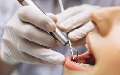 Step By Step Process of Getting Dental Implants