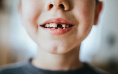 Knocked-Out Tooth: What to Do in the Critical First Hour