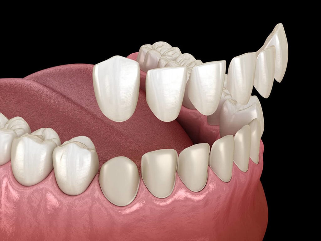 Dental veneers in Scarborough at Everbright Smiles 3D illustration of dental veneers treatment for front teeth